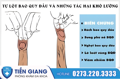 Tác hại nguy hiểm khi tự tuột bao quy đầu tại nhà.